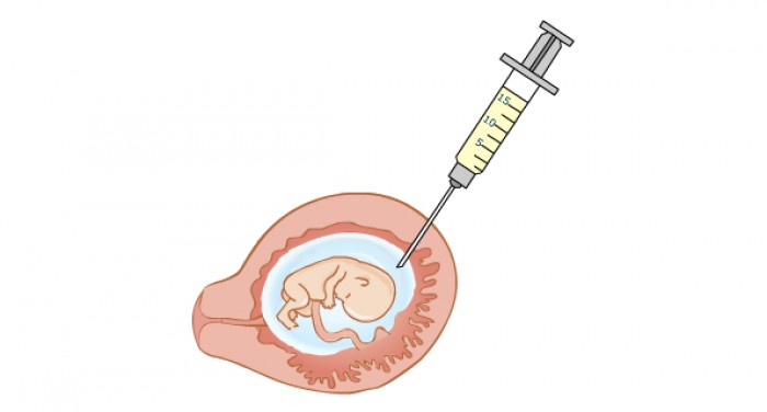 Partera Zoetermeer Vruchtwaterpunctie Is Een Prenatale Invasieve Test